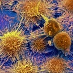 Kidney cancer cells, SEM